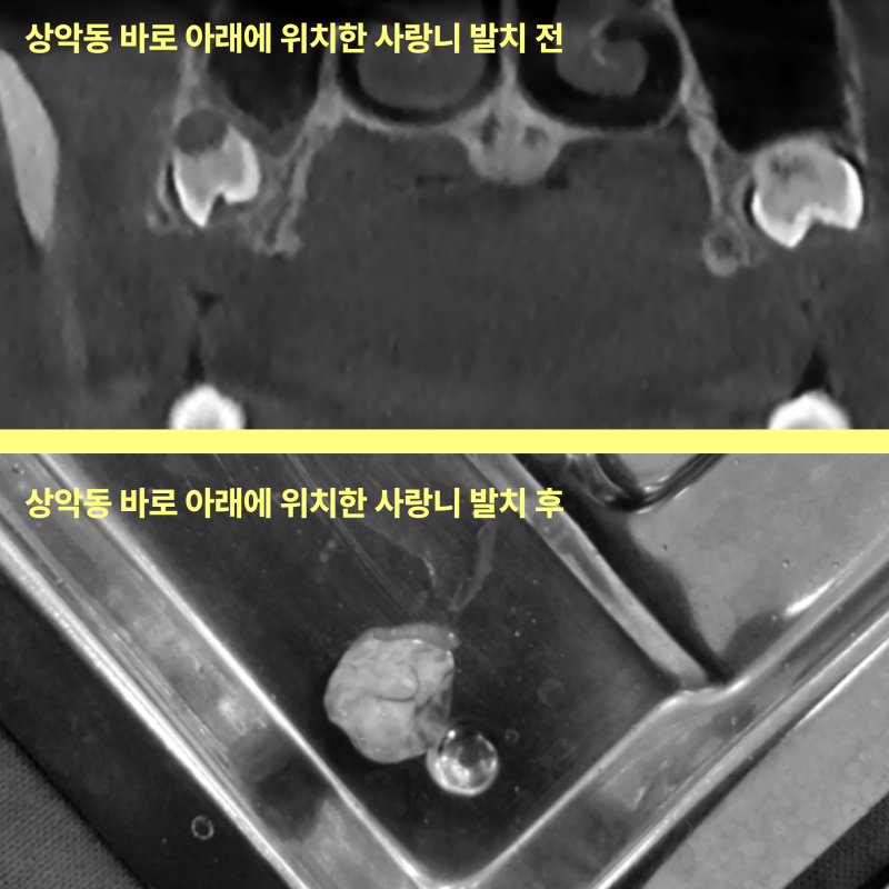 상악동 바로 아래에 위치한 사랑니 발치 전 CT 사진과 발치 후 제거된 사랑니 사진이 위아래로 나열되어 있다.