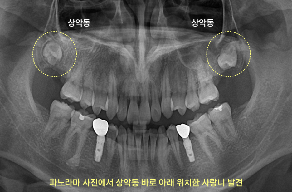 파노라마 방사선 사진에서 상악동 바로 아래에 위치한 사랑니 두 개가 노란색 원으로 표시되어 있다.
