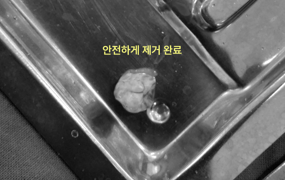 은색 쟁반 위에 발치된 사랑니와 투명한 액체가 놓여 있는 모습