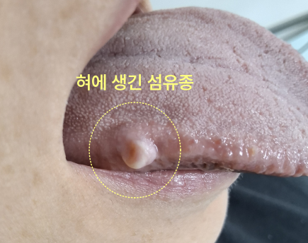 혀에 생긴 섬유종을 확대한 사진