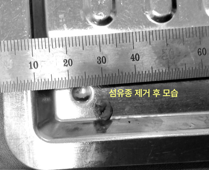 제거된 섬유종과 자가 있는 사진