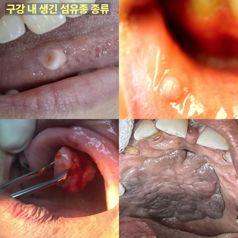 구강 내 생긴 섬유종 종류를 보여주는 4분할 사진