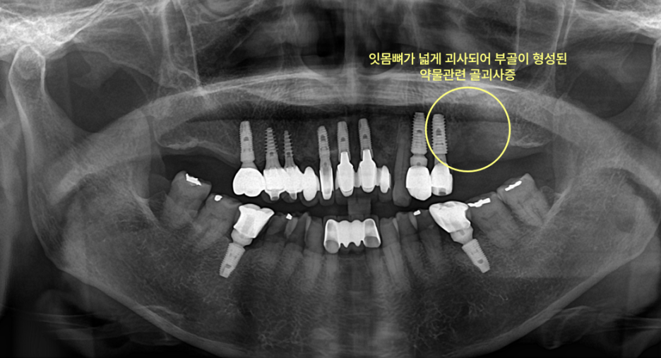 턱뼈 괴사는 왜 전문의 진료가 필요한가요? 4 주안역치과 턱뼈 괴사, 왜 전문의 치료 필요할까요? 관련 사진 2