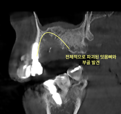 턱뼈 괴사는 왜 전문의 진료가 필요한가요? 6 주안역치과 턱뼈 괴사, 왜 전문의 치료 필요할까요? 관련 사진 4