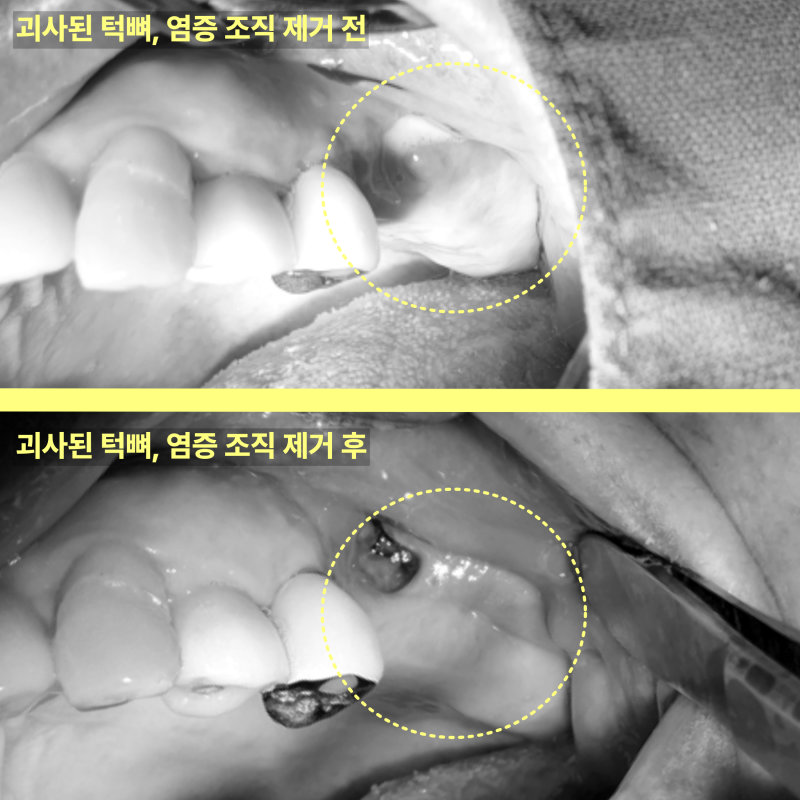 턱뼈 괴사는 왜 전문의 진료가 필요한가요? 10 주안역치과 턱뼈 괴사, 왜 전문의 치료 필요할까요? 관련 사진 8