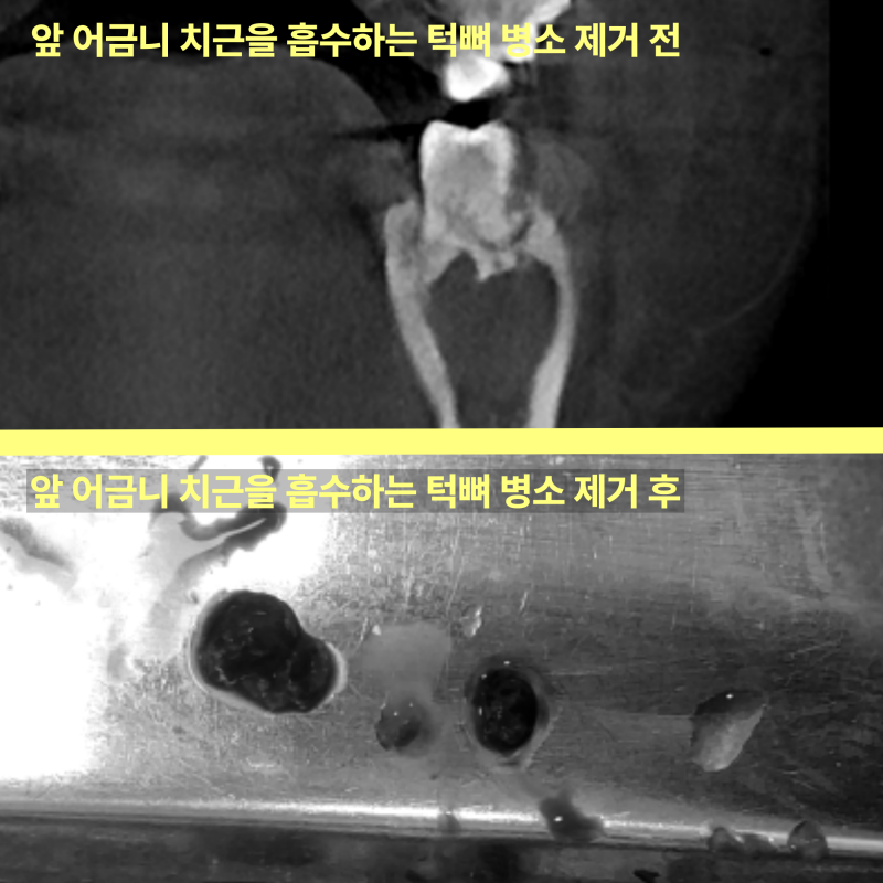앞 어금니 치근을 흡수하는 턱뼈 병소 제거 전후 비교 사진