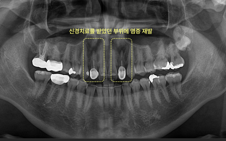 신경치료 부위 염증 재발을 보여주는 파노라마 방사선 사진