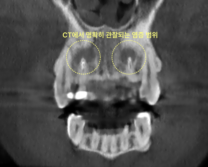 CT 촬영으로 명확히 관찰되는 상악 전치부 염증 범위