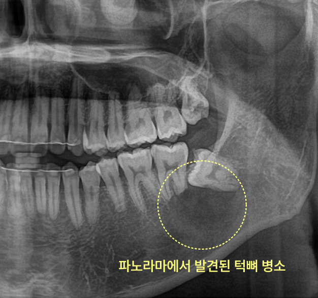 하악 좌측 어금니 부위 턱뼈 병소를 보여주는 파노라마 방사선 사진