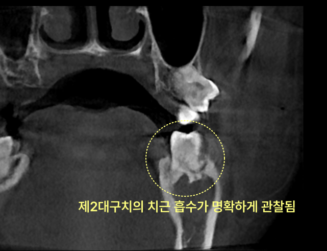CT 촬영으로 관찰되는 하악 좌측 제2대구치의 치근 흡수