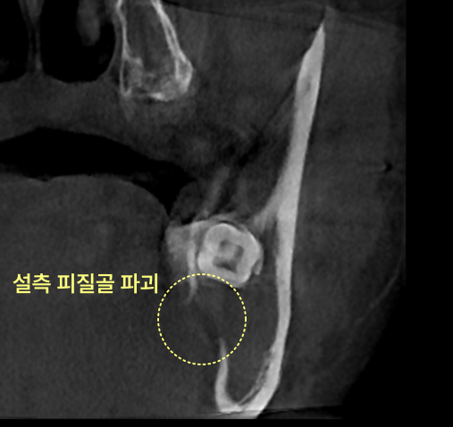 CT 촬영으로 관찰되는 하악 좌측 턱뼈의 설측 피질골 파괴