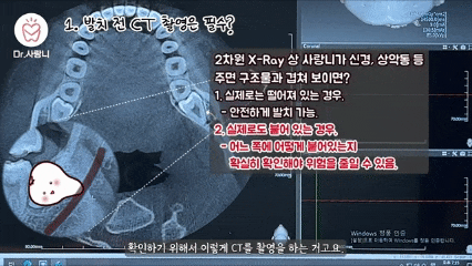 사랑니 발치 전 CT 촬영의 중요성을 설명하는 치과 임상 자료