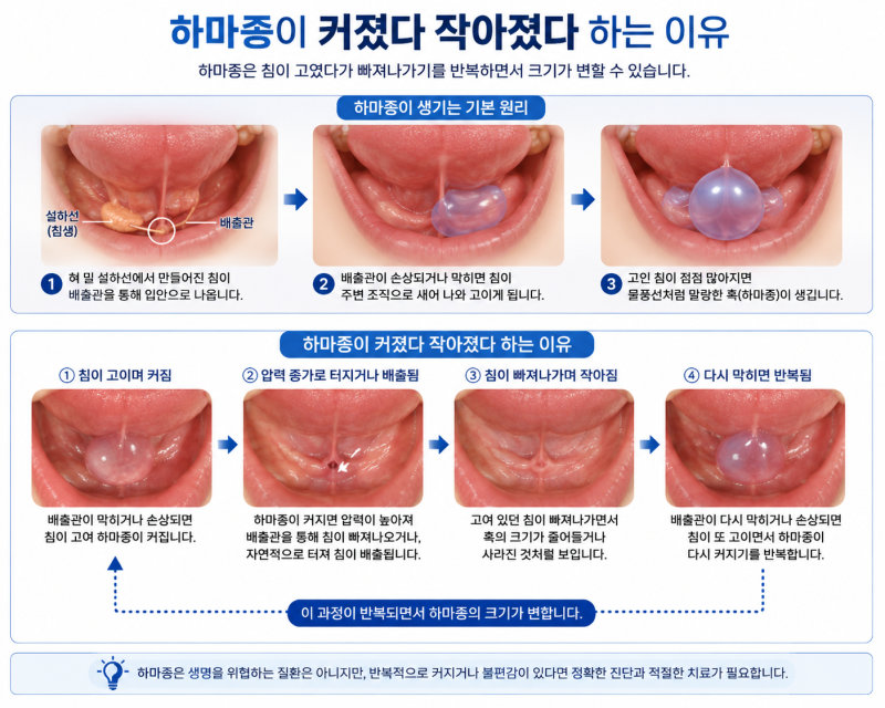 혀 밑 물혹이 작아졌는데 그냥 둬도 되나요? 7 하마종이 커졌다 작아졌다 하는 이유를 설명하는 의료 정보 이미지
