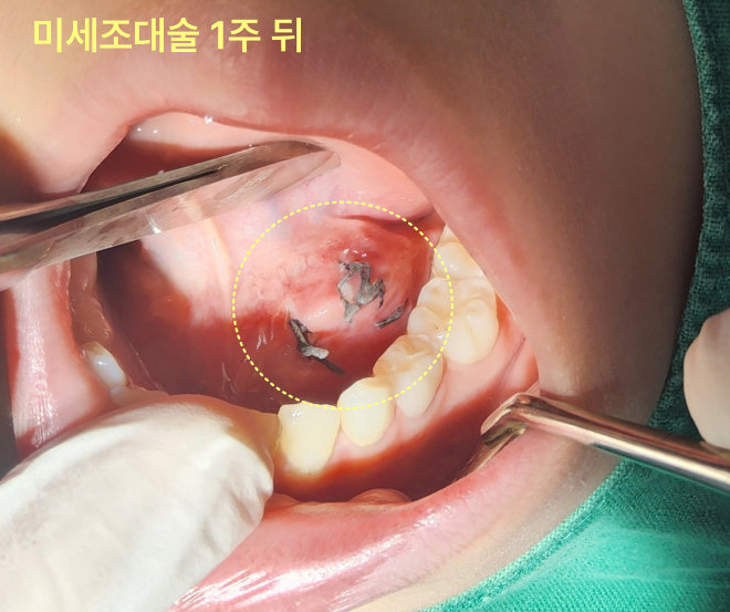 혀 밑 물혹이 작아졌는데 그냥 둬도 되나요? 8 하마종 미세조대술 1주 후 환자의 혀 밑 봉합 부위
