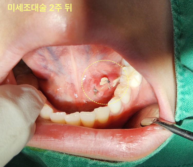혀 밑 물혹이 작아졌는데 그냥 둬도 되나요? 9 하마종 미세조대술 2주 후 환자의 혀 밑 봉합 부위