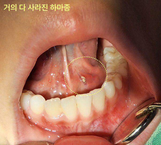 혀 밑 물혹이 작아졌는데 그냥 둬도 되나요? 10 하마종이 거의 사라진 환자의 혀 밑 모습