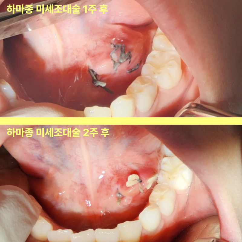 혀 밑 물혹이 작아졌는데 그냥 둬도 되나요? 11 하마종 미세조대술 1주 후와 2주 후의 혀 밑 비교 사진