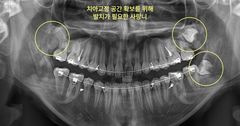 인천사랑니치과 교정 전에 꼭 빼야 할까 4 치아 교정 장치를 착용한 환자의 파노라마 방사선 사진. 노란색 원으로 사랑니 위치를 표시했다.