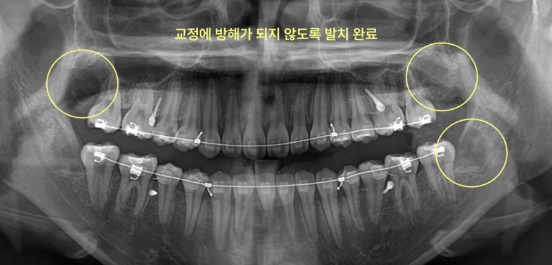 인천사랑니치과 교정 전에 꼭 빼야 할까 6 치아 교정 장치를 착용한 환자의 파노라마 방사선 사진. 노란색 원으로 사랑니 발치 부위를 표시했다.