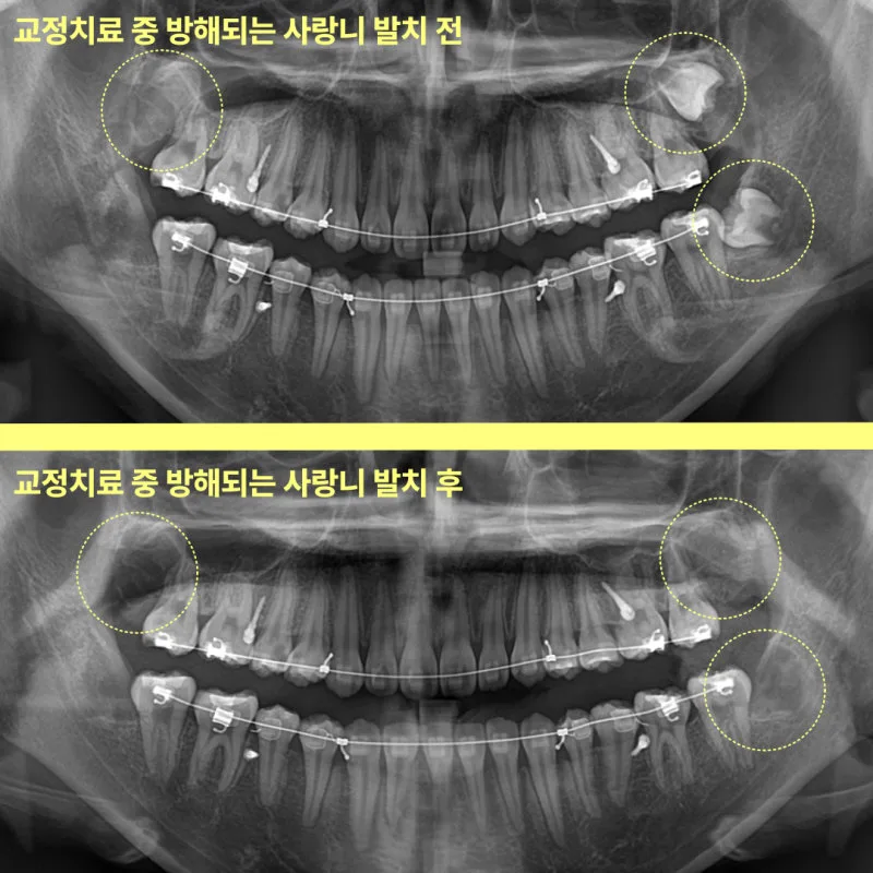 인천사랑니치과 교정 전에 꼭 빼야 할까 9 교정 치료 중 사랑니 발치 전후를 비교하는 파노라마 방사선 사진 두 장