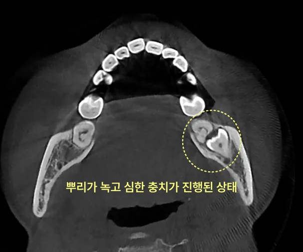 남동구치과 누운 사랑니 옆 충치가 늦게 보이는 까닭 6 누운 사랑니의 뿌리와 심한 충치를 보여주는 치과 CT 사진