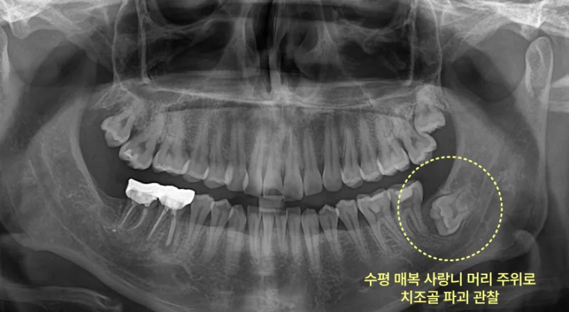 하악 우측 수평 매복 사랑니 주위에 치조골 파괴가 관찰되는 파노라마 방사선 사진