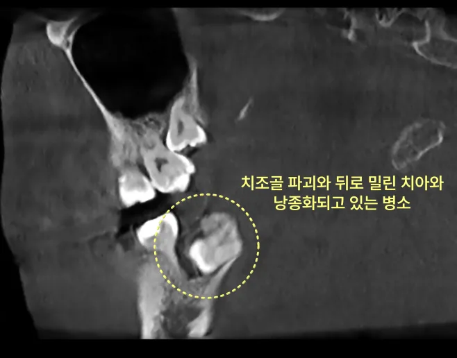하악 우측 수평 매복 사랑니 주위에 치조골 파괴와 낭종화된 병소가 보이는 CT 사진