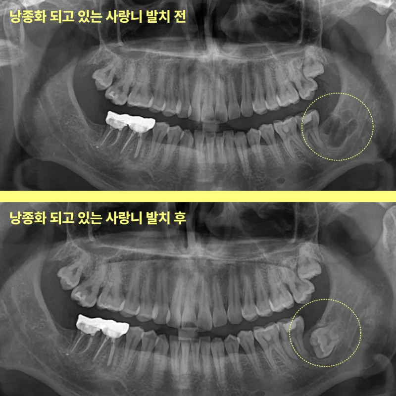 낭종화된 사랑니 발치 전후를 비교하는 파노라마 방사선 사진