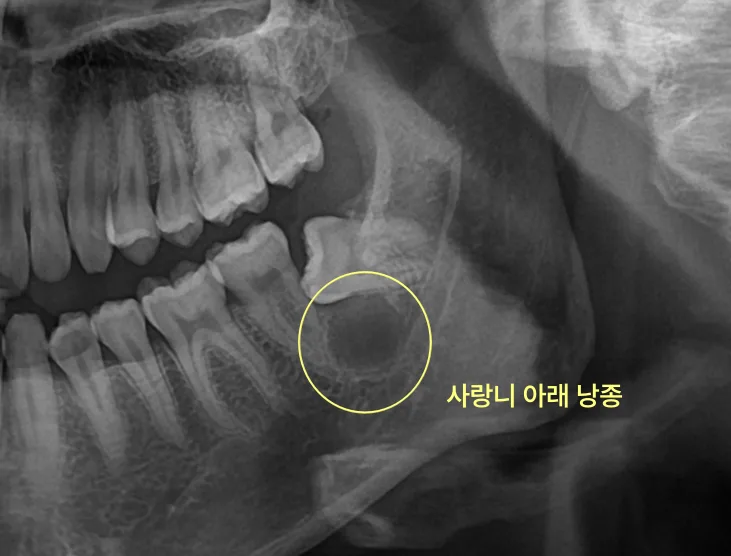 검단신도시치과 안 아픈 사랑니의 검사 기준 4 하악 좌측 사랑니 주변에 노란색 원으로 표시된 낭종이 보이는 파노라마 방사선 사진