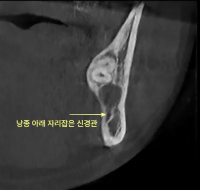 검단신도시치과 안 아픈 사랑니의 검사 기준 6 낭종 아래 신경관이 화살표로 표시된 치아 CT 단면 사진