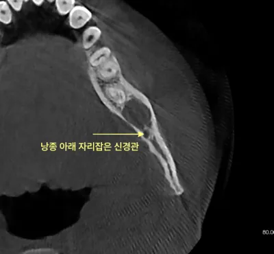 검단신도시치과 안 아픈 사랑니의 검사 기준 7 낭종 아래 신경관이 화살표로 표시된 치아 CT 단면 사진