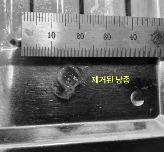 검단신도시치과 안 아픈 사랑니의 검사 기준 8 금속 자 위에 놓여 있는 제거된 낭종 조직