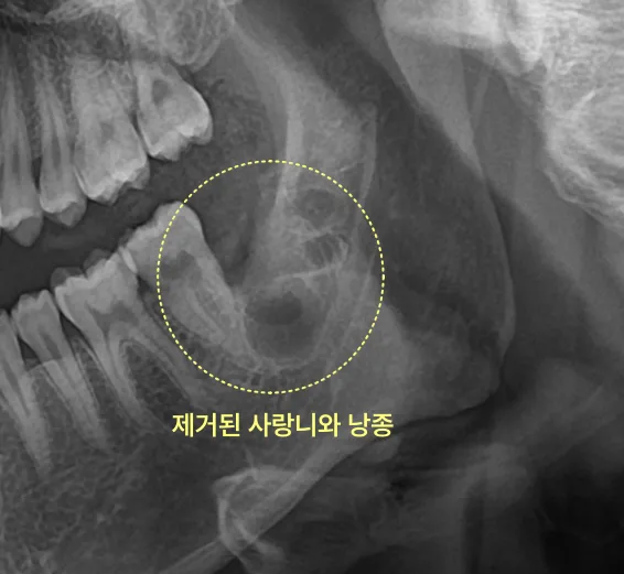 검단신도시치과 안 아픈 사랑니의 검사 기준 9 사랑니와 낭종이 제거된 부위가 노란색 점선 원으로 표시된 파노라마 방사선 사진