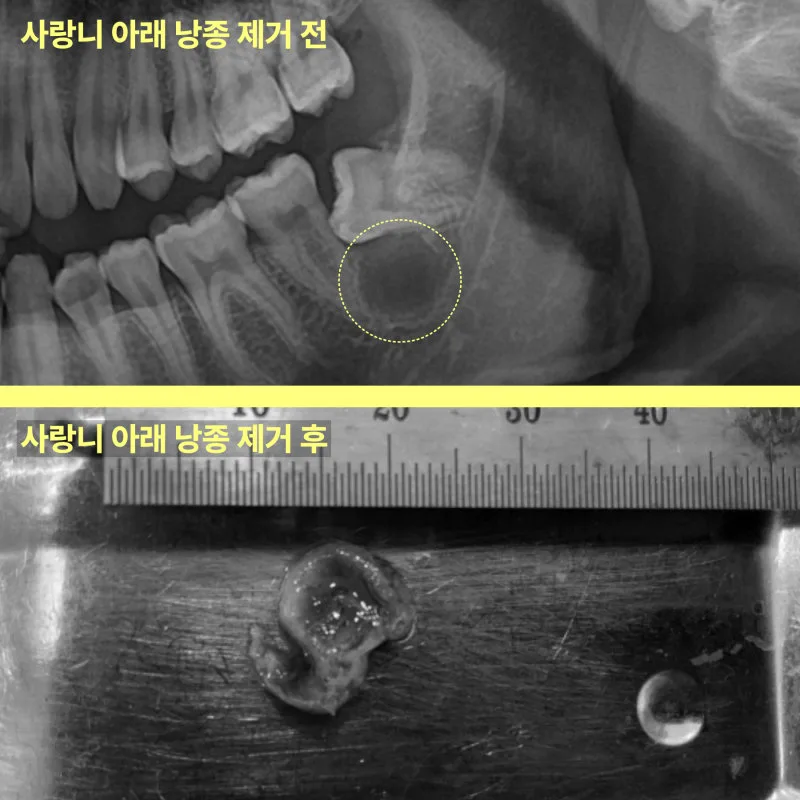검단신도시치과 안 아픈 사랑니의 검사 기준 10 사랑니 아래 낭종 제거 전 파노라마 방사선 사진과 제거 후 낭종 조직 사진이 위아래로 배치된 이미지