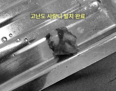 구월동치과 인천 사랑니 전문, 쉬운 발치는 없다 관련 사진 5