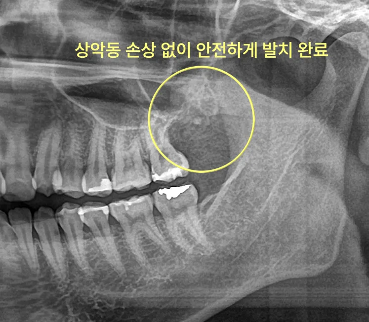 구월동치과 인천 사랑니 전문, 쉬운 발치는 없다 관련 사진 6
