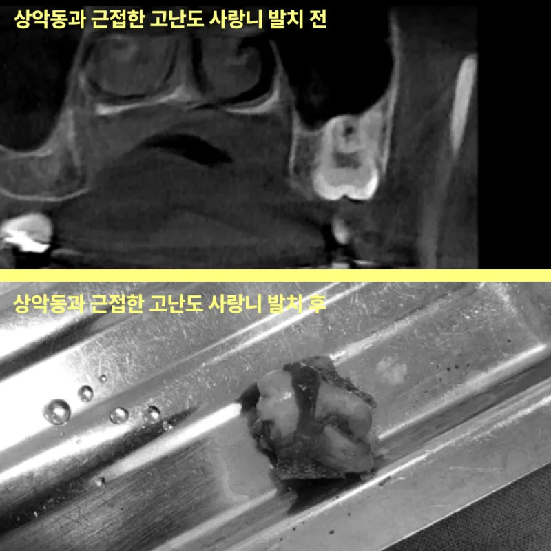 구월동치과 인천 사랑니 전문, 쉬운 발치는 없다 관련 사진 7