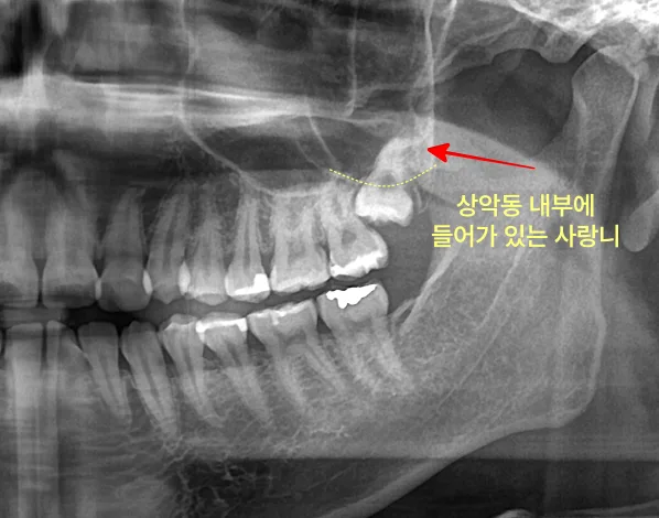 파노라마 방사선 사진으로 본 상악동 내부에 위치한 사랑니
