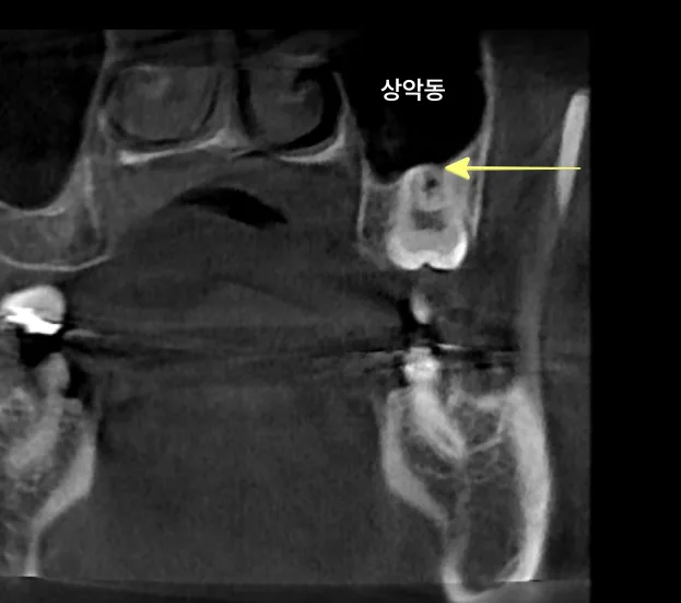 CT 촬영 사진으로 본 상악동 내부에 위치한 사랑니