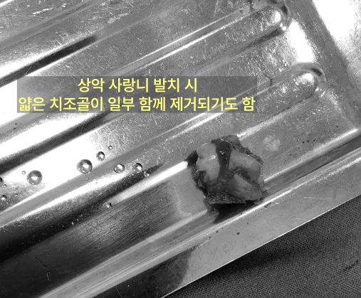 발치된 상악 사랑니와 함께 제거된 얇은 치조골 조각