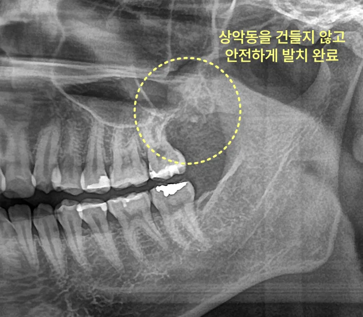 상악동을 건드리지 않고 사랑니 발치를 완료한 파노라마 방사선 사진
