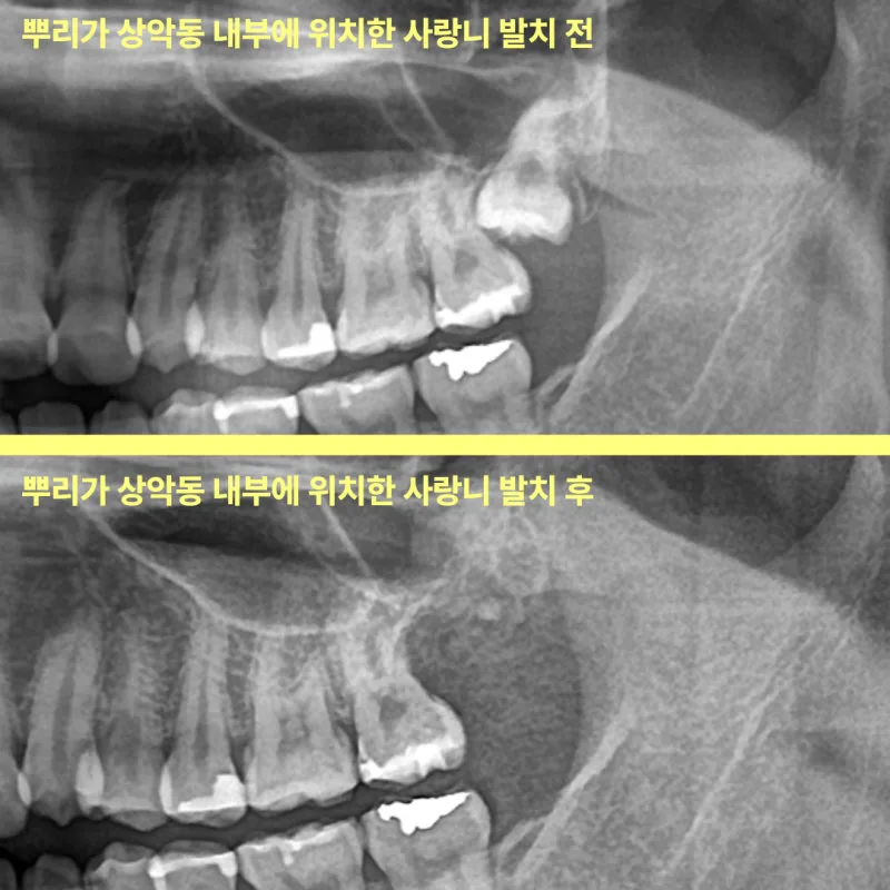 뿌리가 상악동 내부에 위치한 사랑니의 발치 전후 파노라마 방사선 사진 비교