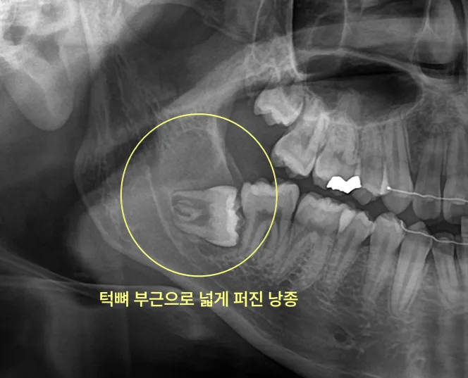 하악 좌측 어금니 부위 파노라마 방사선 사진