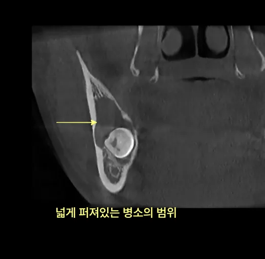 하악 좌측 어금니 부위 CT 단면 사진