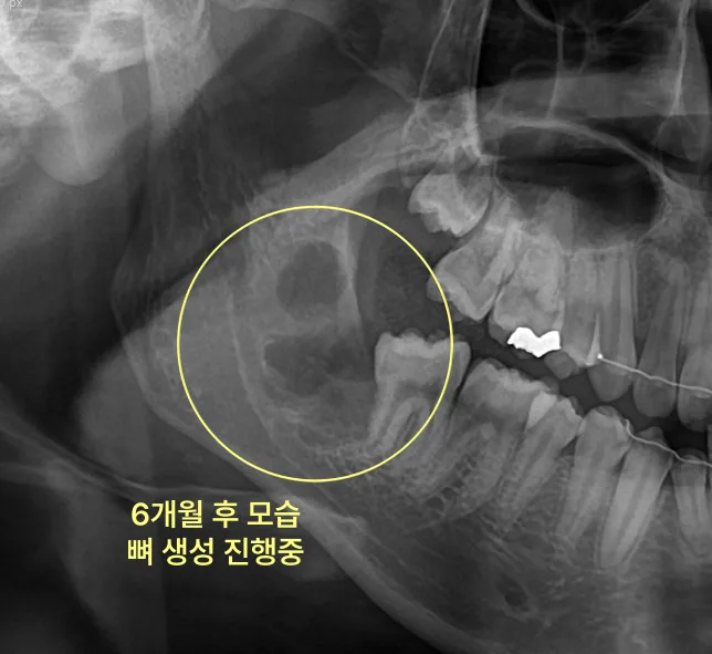 하악 좌측 어금니 부위 낭종 제거 6개월 후 파노라마 방사선 사진