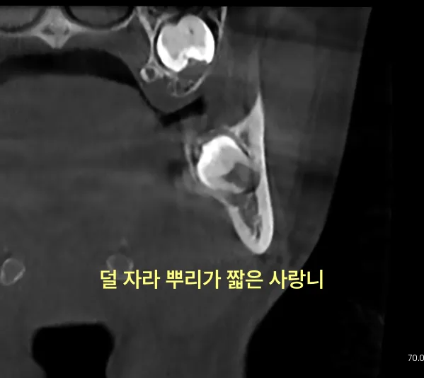 구월동치과 미성숙 사랑니 발치, 뿌리 덜 자랐을 때 뺄까? 5 하악 좌측 사랑니의 치과 CT 횡단면 사진으로, 뿌리가 짧게 형성된 미성숙 사랑니가 보임