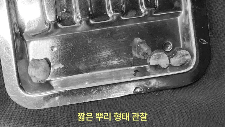 구월동치과 미성숙 사랑니 발치, 뿌리 덜 자랐을 때 뺄까? 6 발치된 사랑니들이 놓인 스테인리스 쟁반 클로즈업 사진
