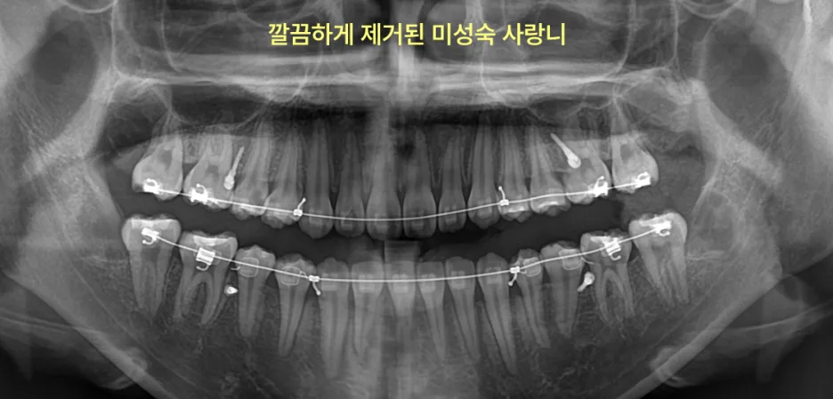 구월동치과 미성숙 사랑니 발치, 뿌리 덜 자랐을 때 뺄까? 7 치아 교정 장치를 착용한 환자의 파노라마 방사선 사진에서 사랑니가 제거된 모습