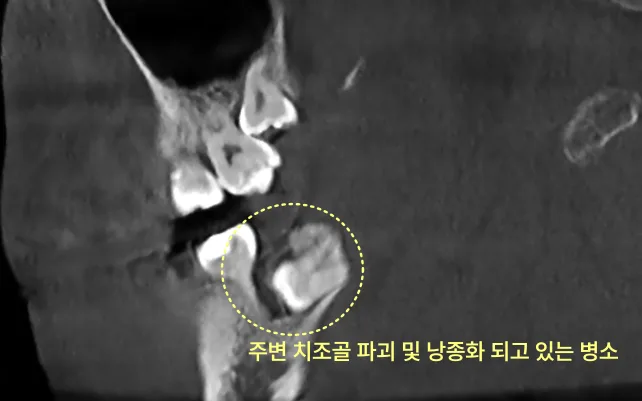 하악 우측 매복 사랑니 주변 치조골 파괴 및 낭종화된 CT 사진