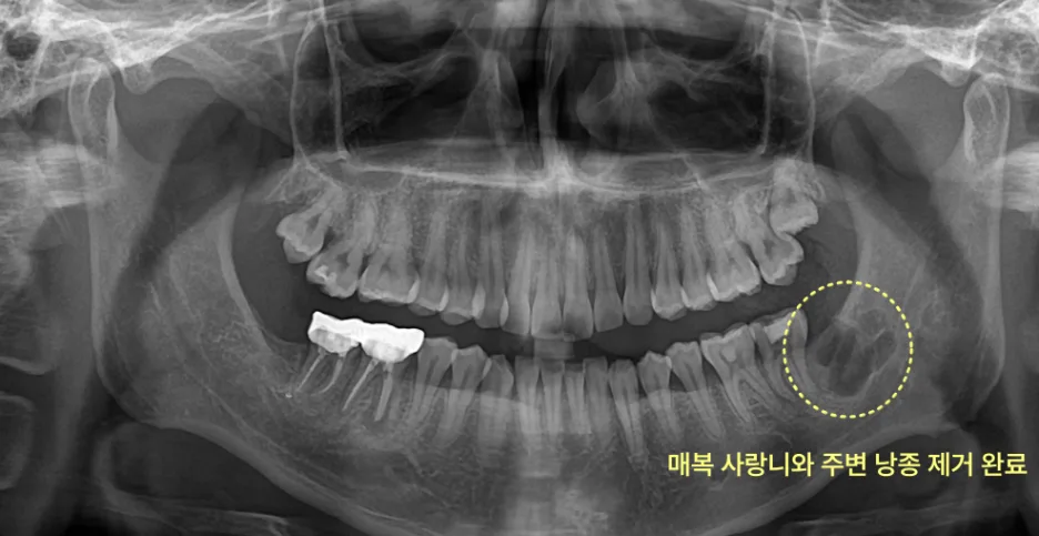 하악 우측 매복 사랑니와 주변 낭종 제거 후 파노라마 방사선 사진